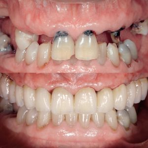 عکس ایمپلنت دندان جلو قبل و بعد